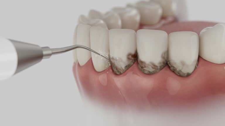 Reliable Dental Implants contractor in Pelican Marsh, FL by Smile Center Dentistry